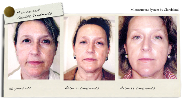 microcurrent facelift treatments with Microcurrent System by Clareblend